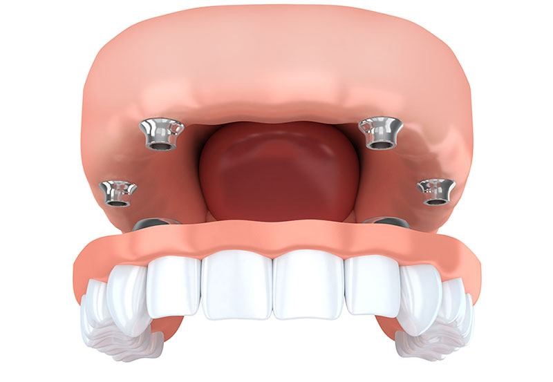 Kalinjax Dentures Ethel MS 39067